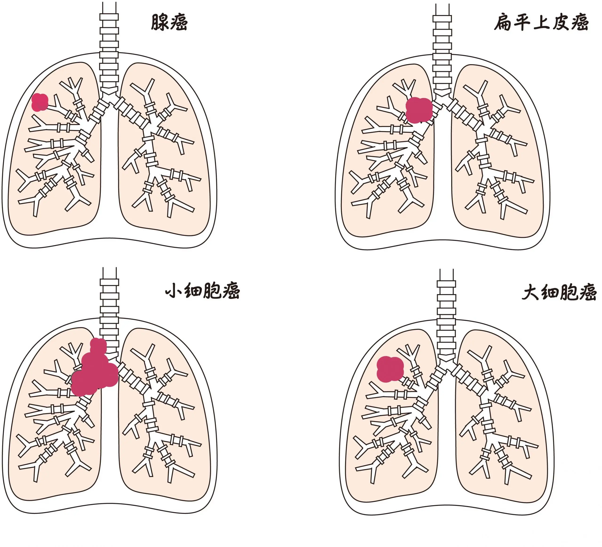 肺癌 (4コマあり) | 中村橋いとう内科クリニック